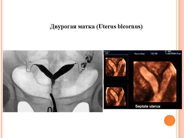 Двурогая матка (Uterus bicornus) 