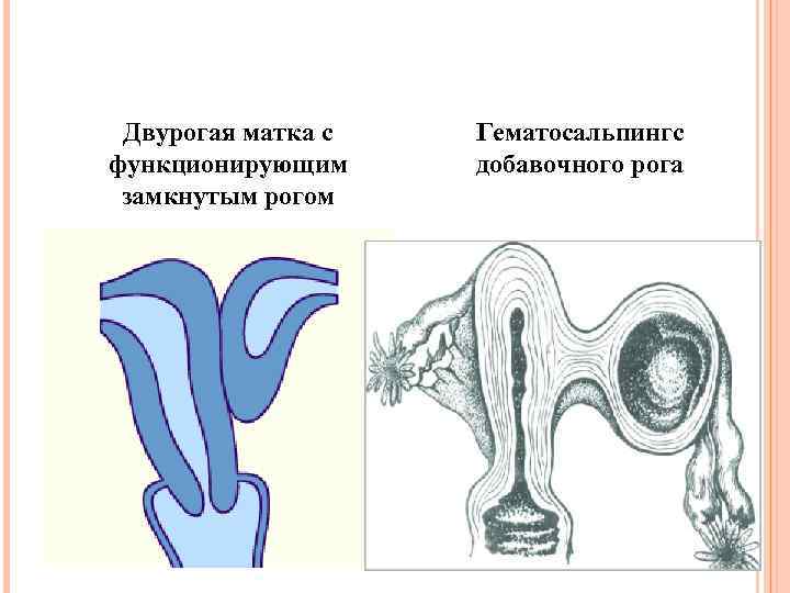 Двурогая матка с функционирующим замкнутым рогом Гематосальпингс добавочного рога 