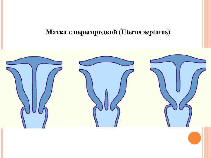 Матка с перегородкой (Uterus septatus) 