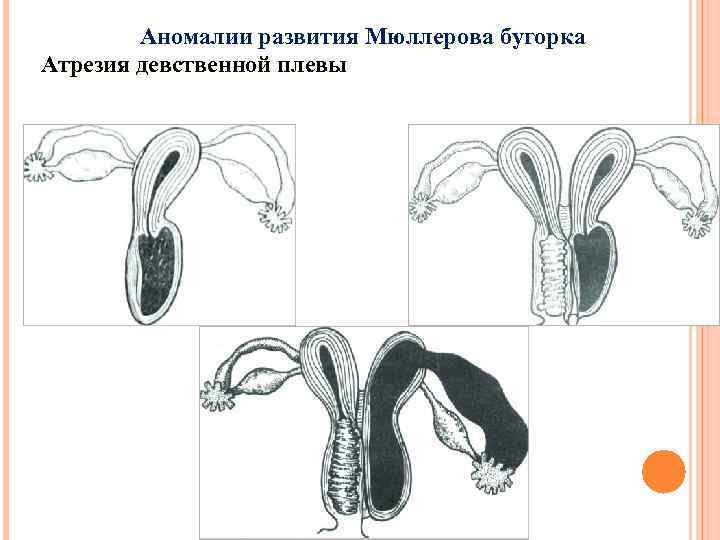 Аномалии развития Мюллерова бугорка Атрезия девственной плевы 