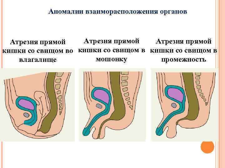 Аномалии взаиморасположения органов Атрезия прямой кишки со свищом во кишки со свищом в мошонку