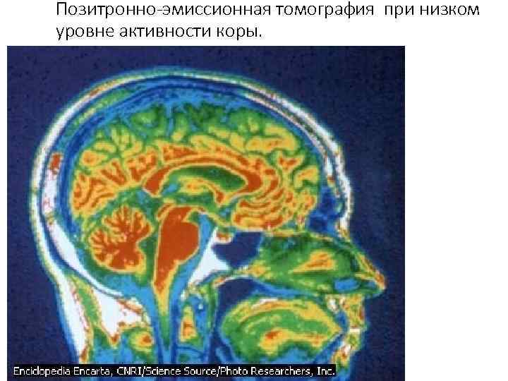 Позитронно-эмиссионная томография при низком уровне активности коры. 