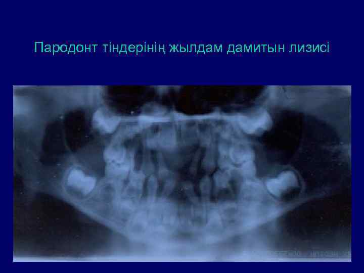 Пародонт тіндерінің жылдам дамитын лизисі 