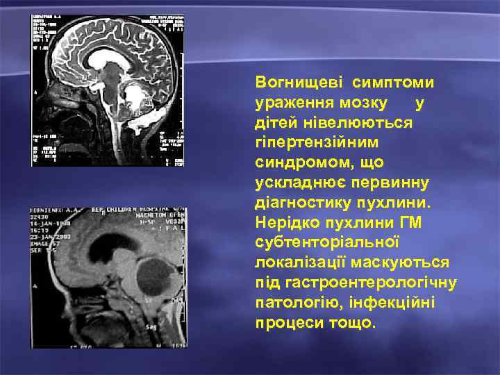 Вогнищеві симптоми ураження мозку у дітей нівелюються гіпертензійним синдромом, що ускладнює первинну діагностику пухлини.