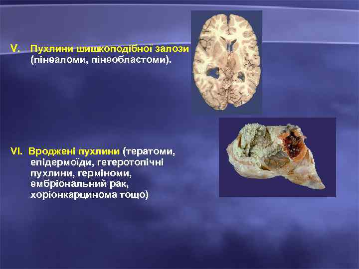 V. Пухлини шишкоподібної залози (пінеаломи, пінеобластоми). VI. Вроджені пухлини (тератоми, епідермоїди, гетеротопічні пухлини, герміноми,