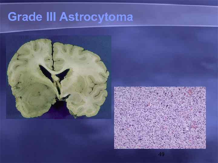 Grade III Astrocytoma 49 