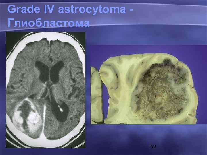 Grade IV astrocytoma Глиобластома 52 