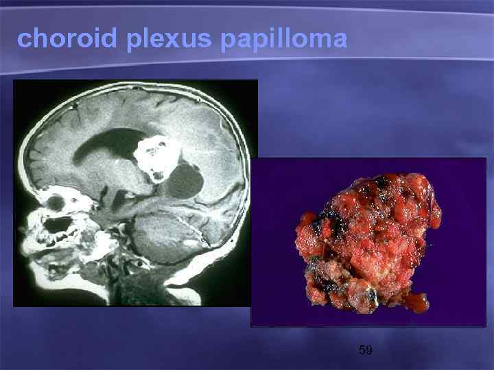 choroid plexus papilloma 59 