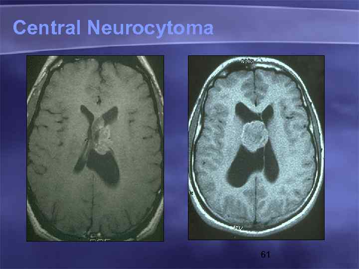 Central Neurocytoma 61 