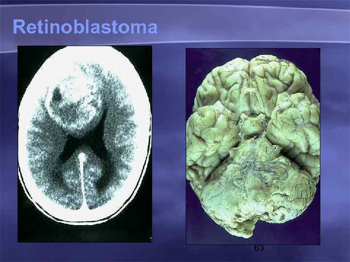 Retinoblastoma 63 