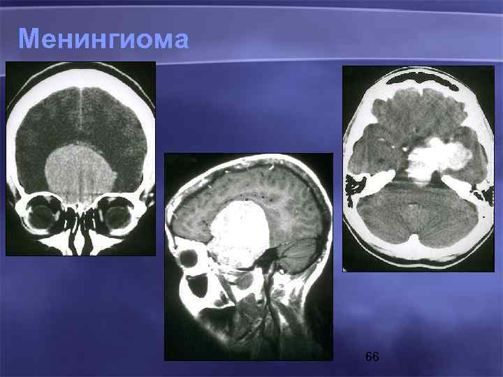 Менингиома 66 