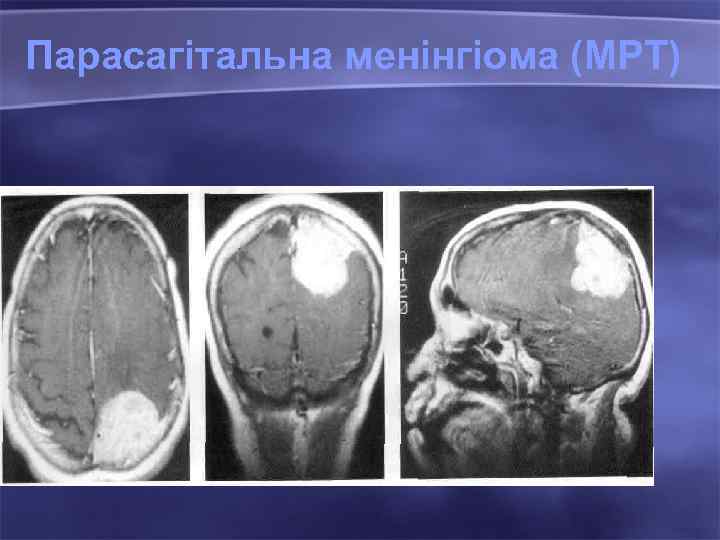 Парасагітальна менінгіома (МРТ) 