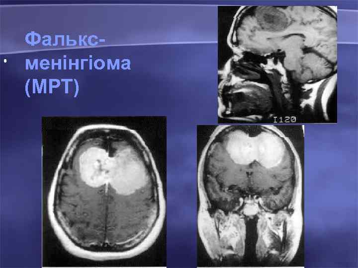  • Фальксменінгіома (МРТ) 