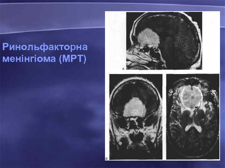 Ринольфакторна менінгіома (МРТ) 