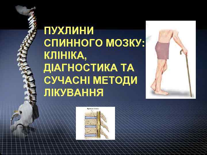ПУХЛИНИ СПИННОГО МОЗКУ: КЛІНІКА, ДІАГНОСТИКА ТА СУЧАСНІ МЕТОДИ ЛІКУВАННЯ 