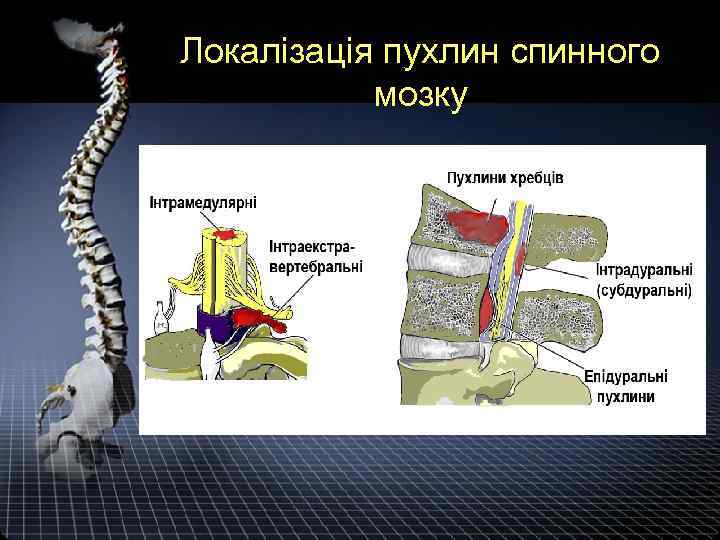 Локалізація пухлин спинного мозку 