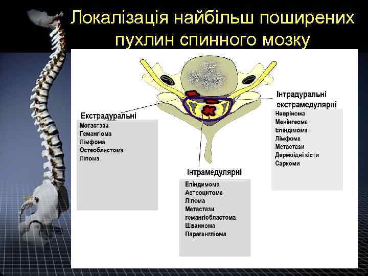 Локалізація найбільш поширених пухлин спинного мозку 