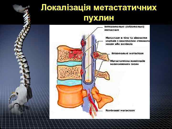 Локалізація метастатичних пухлин 