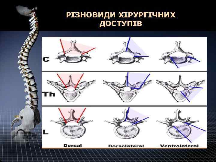 РІЗНОВИДИ ХІРУРГІЧНИХ ДОСТУПІВ 