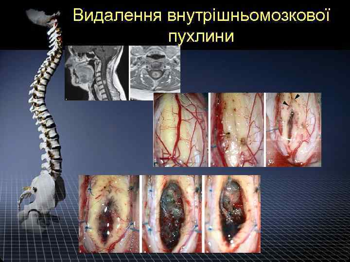 Видалення внутрішньомозкової пухлини 