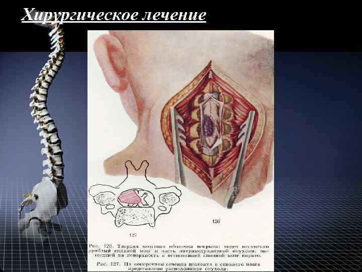 Хирургическое лечение 