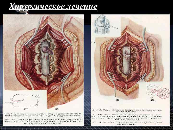 Хирургическое лечение 
