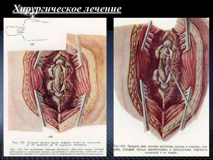 Хирургическое лечение 