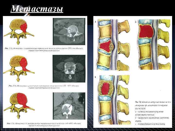 Метастазы 