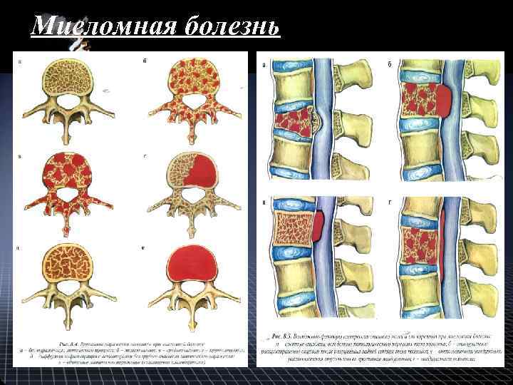 Миеломная болезнь 