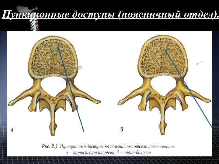 Пункционные доступы (поясничный отдел). 