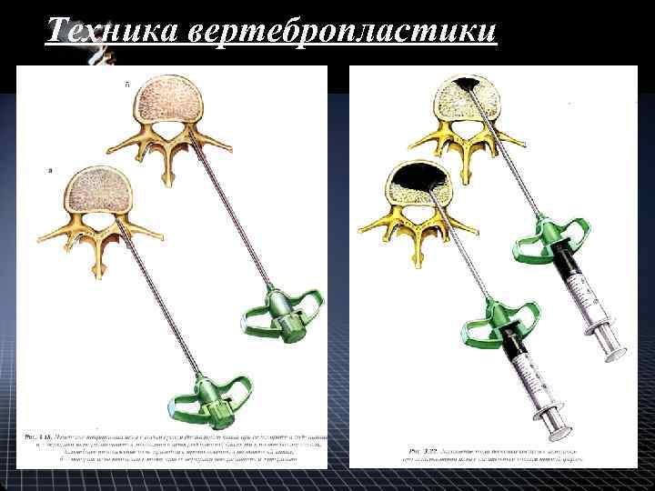 Техника вертебропластики 
