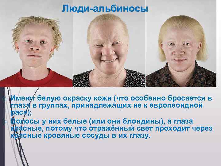 Как люди рождаются альбиносами. Генные болезни альбинизм. Альбинизм хромосомная мутация. Альбинизм генная мутация. Альбинизм наследственное заболевание.