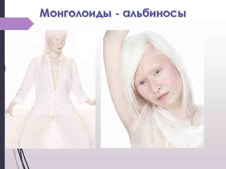 Монголоиды - альбиносы 