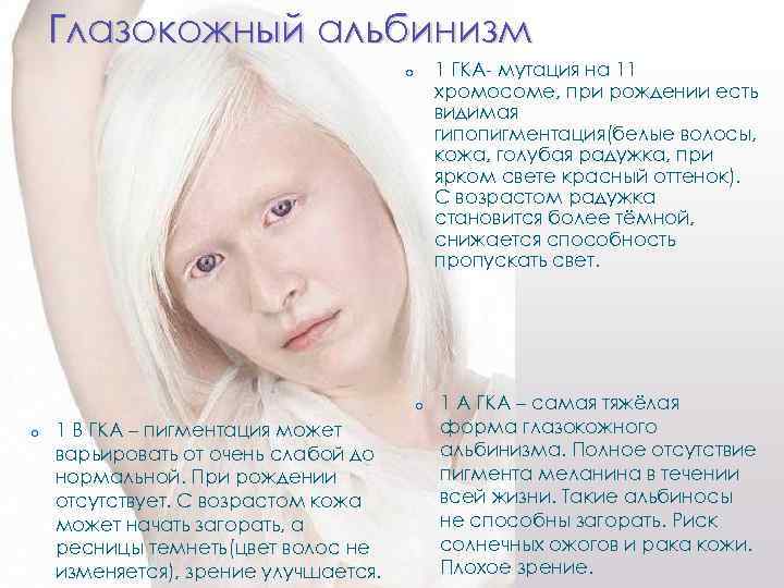 Альбинизмом страдают. Глазокожный альбинизм 1 ГКА. Глазокожный альбинизм 1гка хромосома. Глазокожный альбинизм 1 а. Глазокожный альбинизм Тип 1а.