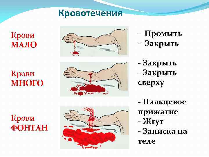 Кровотечения Крови МАЛО - Промыть - Закрыть Крови МНОГО - Закрыть сверху Крови ФОНТАН
