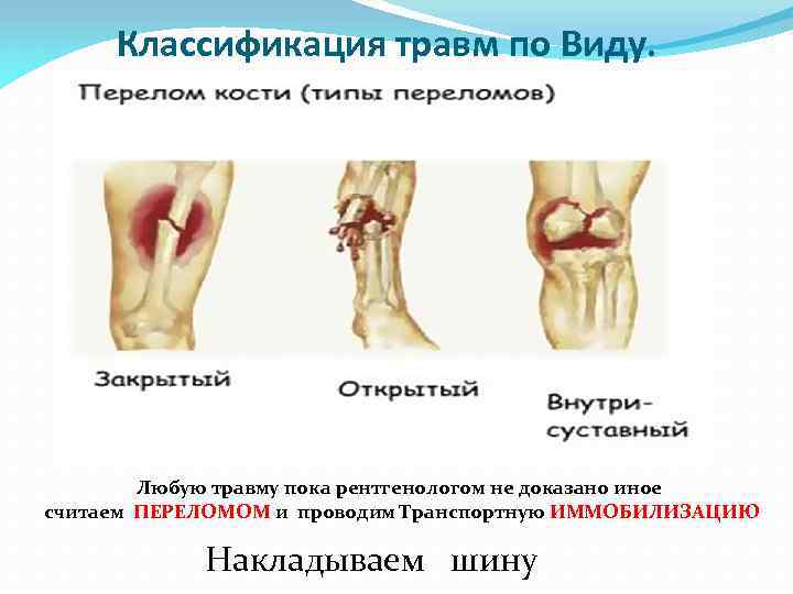 Классификация травм по Виду. Любую травму пока рентгенологом не доказано иное считаем ПЕРЕЛОМОМ и