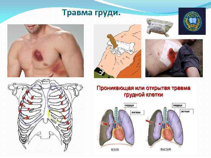 Травма груди. 