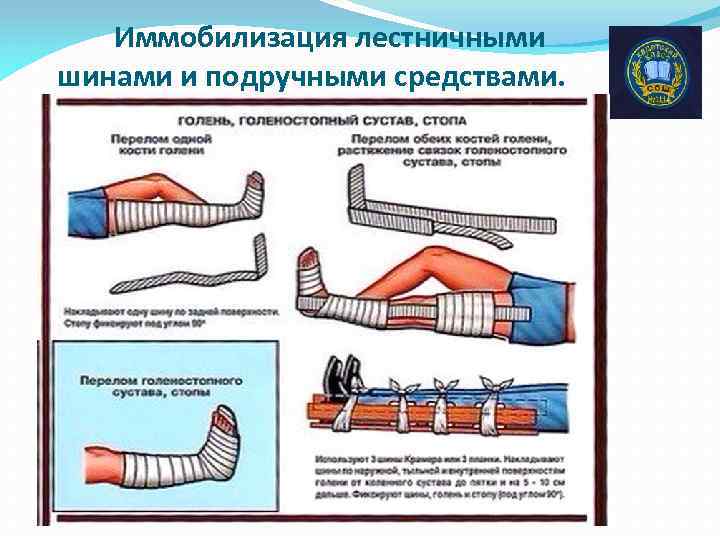 Иммобилизация в каких случаях. Проволочная шина Крамера. Шина проволочная лестничная для ног для кабинета ОБЖ. Иммобилизация верхней конечности из подручных средств. Иммобилизация шиной Крамера.