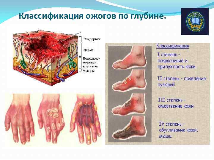 Классификация ожогов по глубине. 