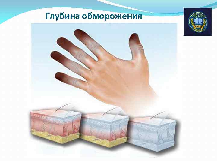 Глубина обморожения 