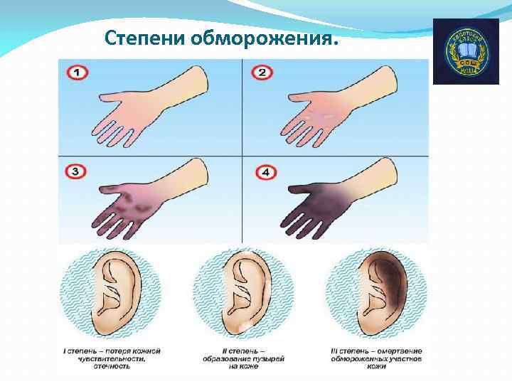 Степени обморожения. 