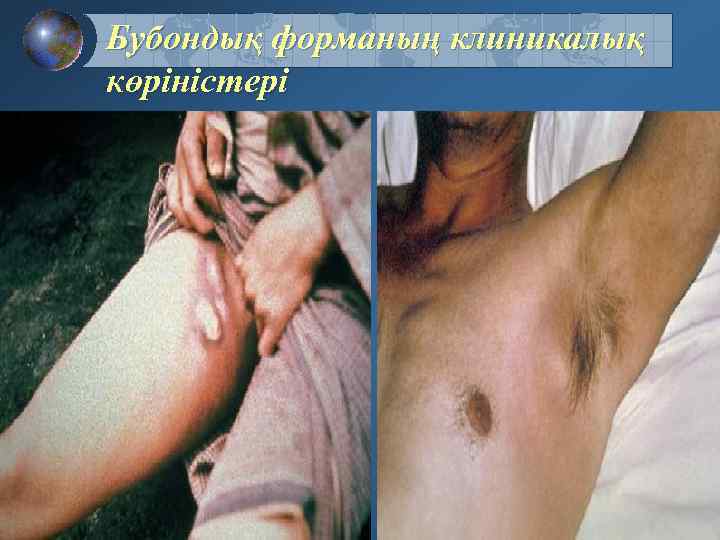 Бубондық форманың клиникалық көріністері 
