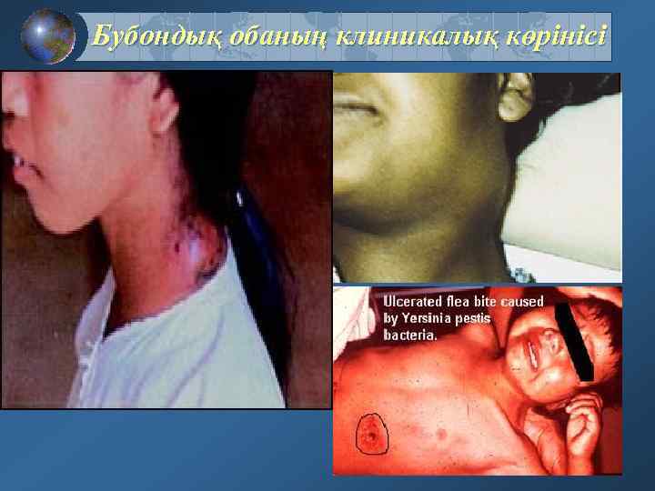 Бубондық обаның клиникалық көрінісі 