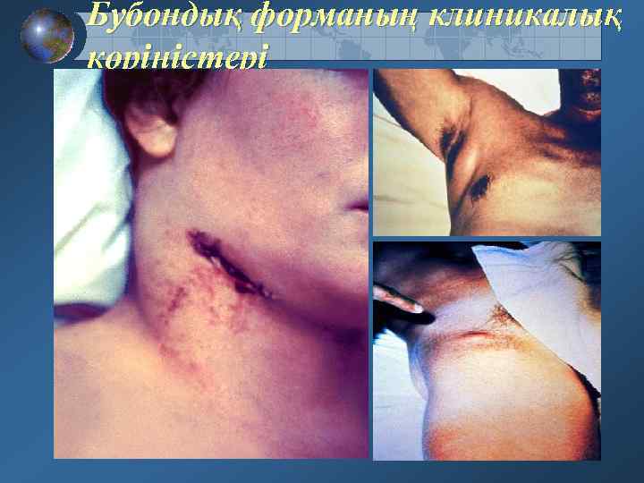 Бубондық форманың клиникалық көріністері 