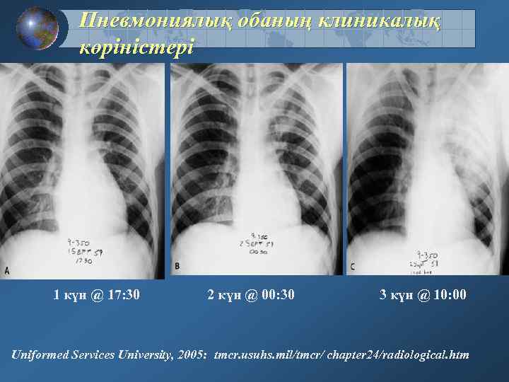 Пневмониялық обаның клиникалық көріністері 1 күн @ 17: 30 2 күн @ 00: 30