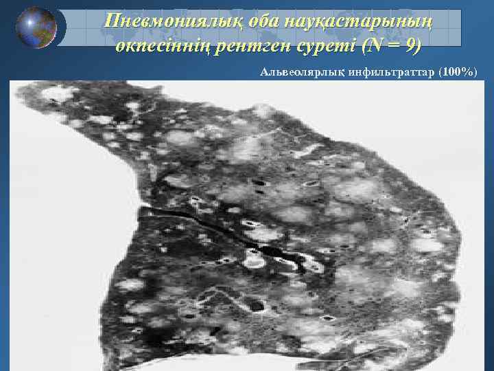 Пневмониялық оба науқастарының өкпесіннің рентген суреті (N = 9) Альвеолярлық инфильтраттар (100%) 