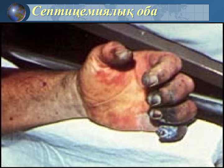 Септицемиялық оба 