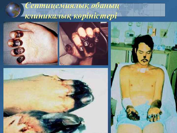 Септицемиялық обаның клиникалық көріністері 