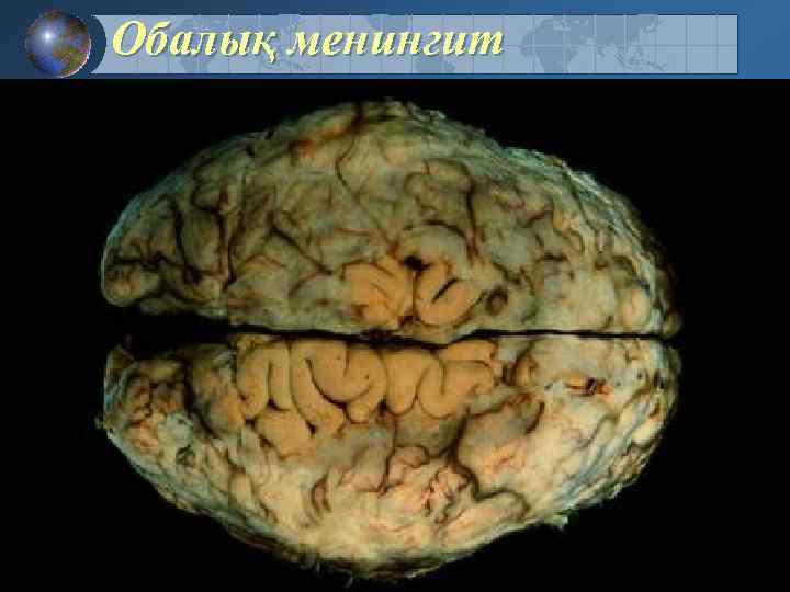 Обалық менингит 