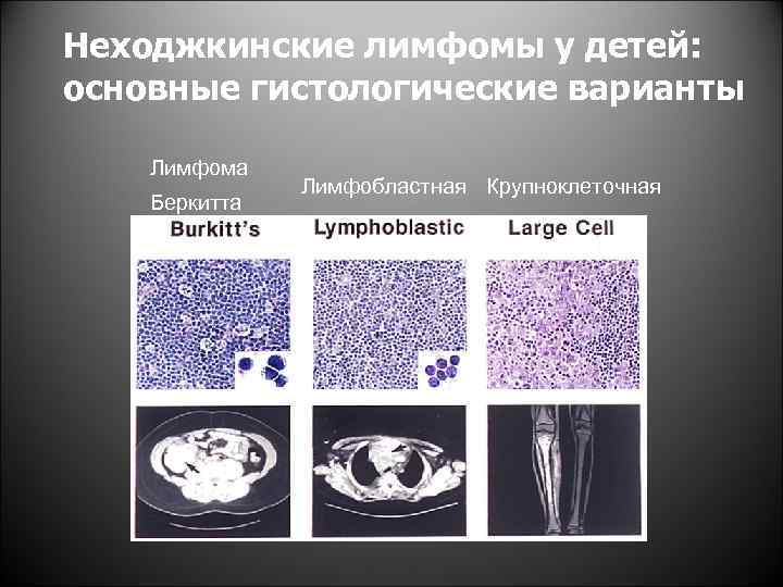 Неходжкинская лимфома презентация